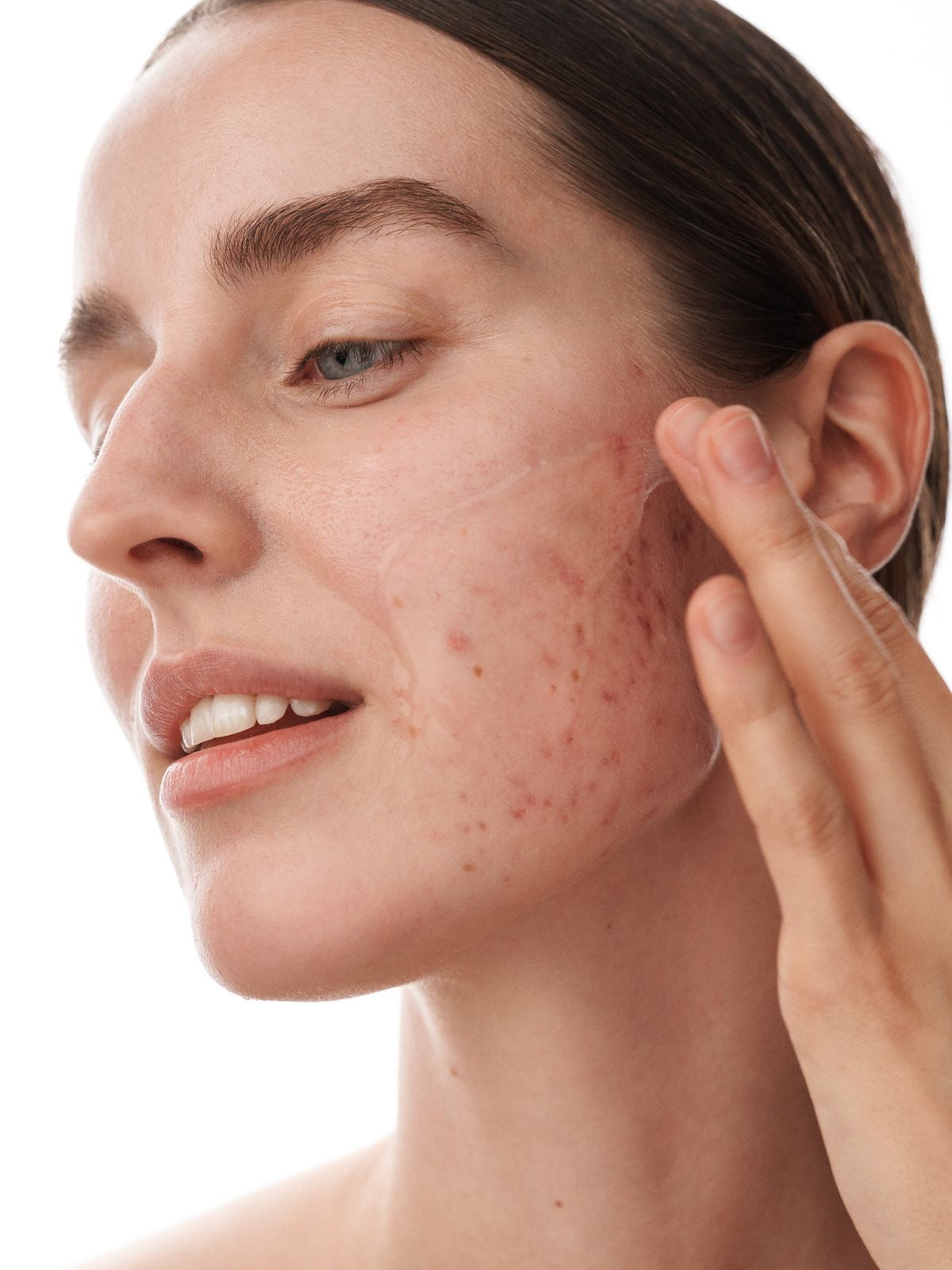 Gel Anti imperfecciones