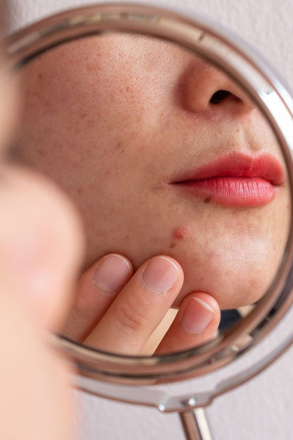Gel Anti imperfecciones
